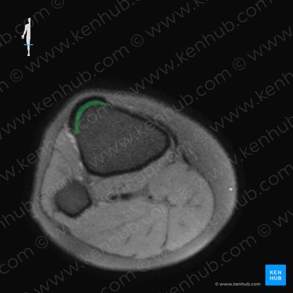 Tibial tuberosity (Tuberositas tibiae); Image: 