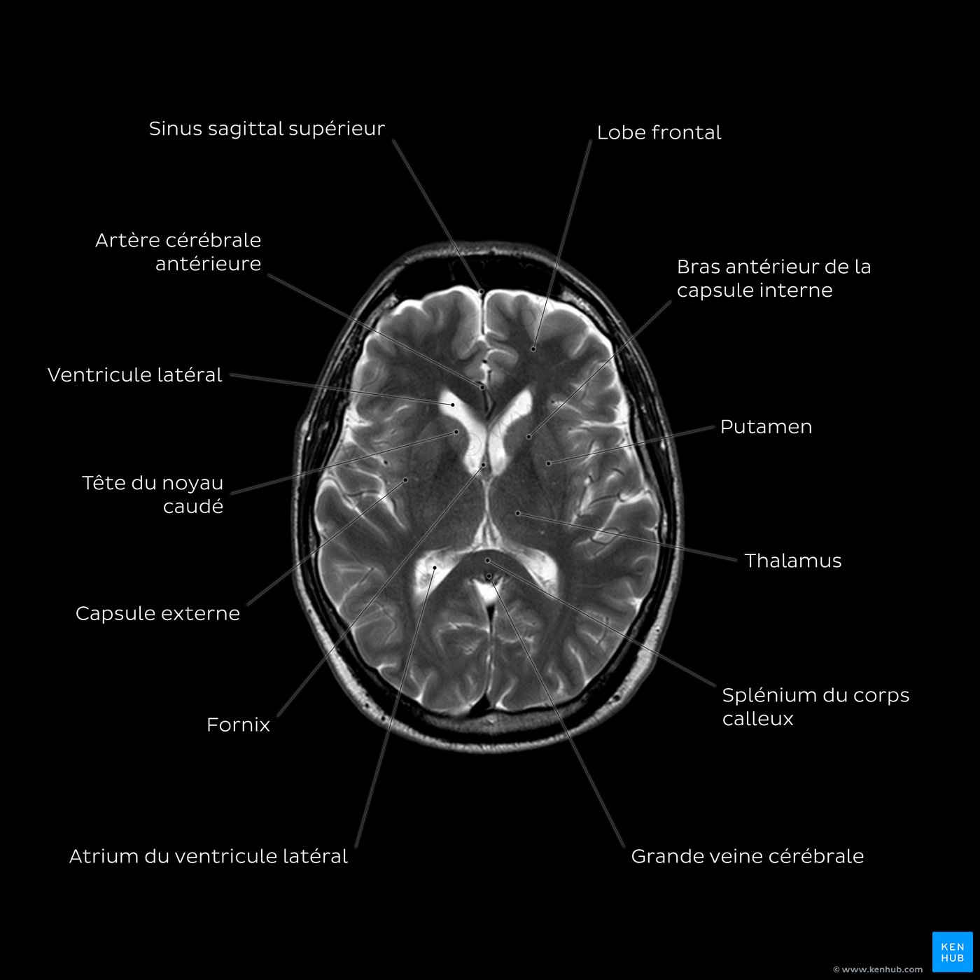 Brain MRI (T2w) - Thalamus level