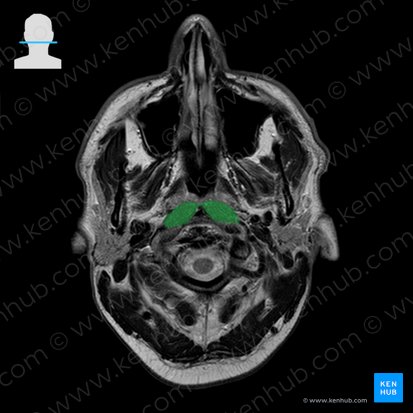 Longus capitis muscle (Musculus longus capitis); Image: 