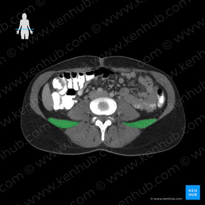 Musculus quadratus lumborum (Viereckiger Lendenmuskel); Bild: 