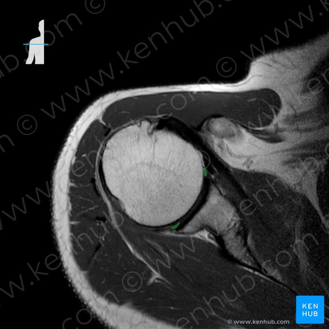 Labrum glenoidale scapulae (Gelenklippe des Schulterblatts); Bild: 