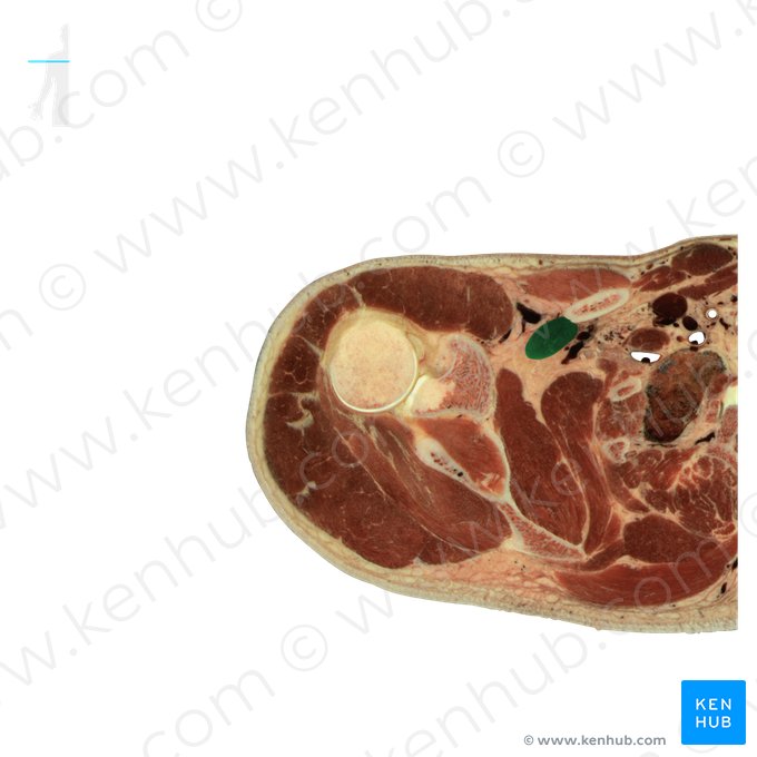 Subclavius muscle (Musculus subclavius); Image: National Library of Medicine