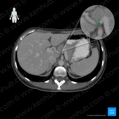 Left gastric vein (Vena gastrica sinistra); Image: 