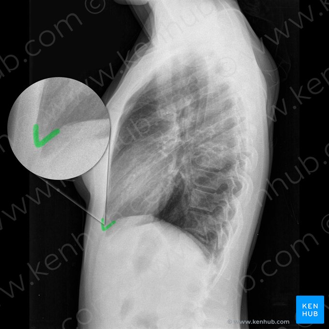 Right anterior costophrenic angle (Angulus costophrenicus anterior dexter); Image: 
