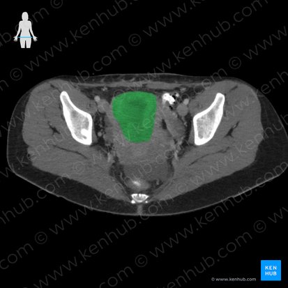 Uterus; Image: 