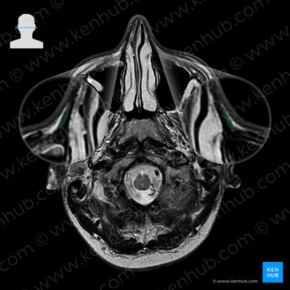 Nasalis muscle (Musculus nasalis); Image: 