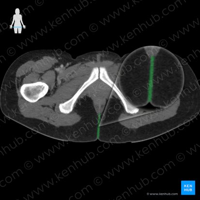 Hendidura interglútea (Crena interglutealis); Imagen: 