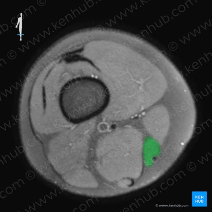 Musculus gracilis (Schlankmuskel); Bild: 