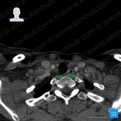 Longus colli muscle (Musculus longus colli); Image: 