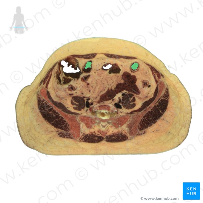 Sigmoid colon (Colon sigmoideum); Image: National Library of Medicine