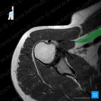 Pectoralis minor muscle (Musculus pectoralis minor); Image: 