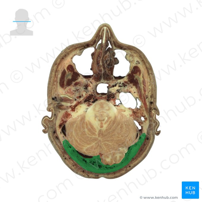 Occipital bone (Os occipitale); Image: National Library of Medicine
