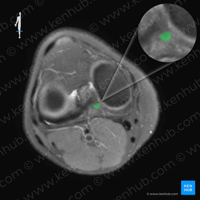 Posterior cruciate ligament (Ligamentum cruciatum posterius); Image: 