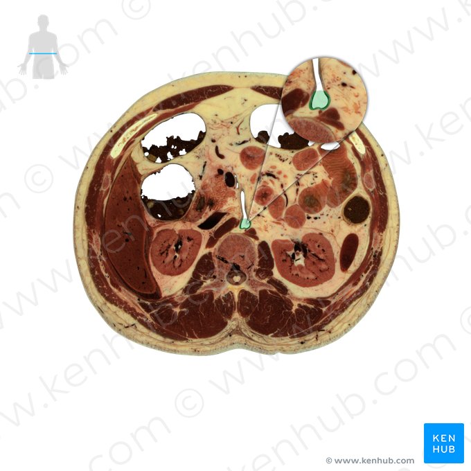 Aorta abdominal (Aorta abdominalis); Imagem: National Library of Medicine