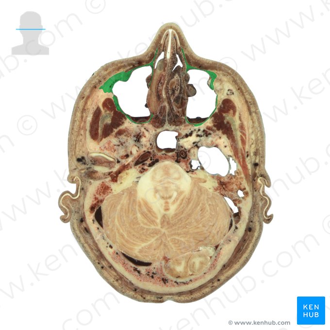 Maxilla; Image: National Library of Medicine