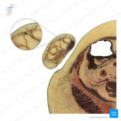 Tendon of extensor pollicis longus muscle (Tendo musculi extensoris pollicis longi); Image: National Library of Medicine