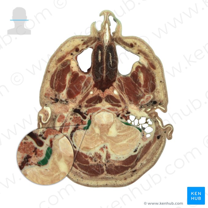 Sinus sigmoideus (S-förmiger Blutleiter); Bild: National Library of Medicine