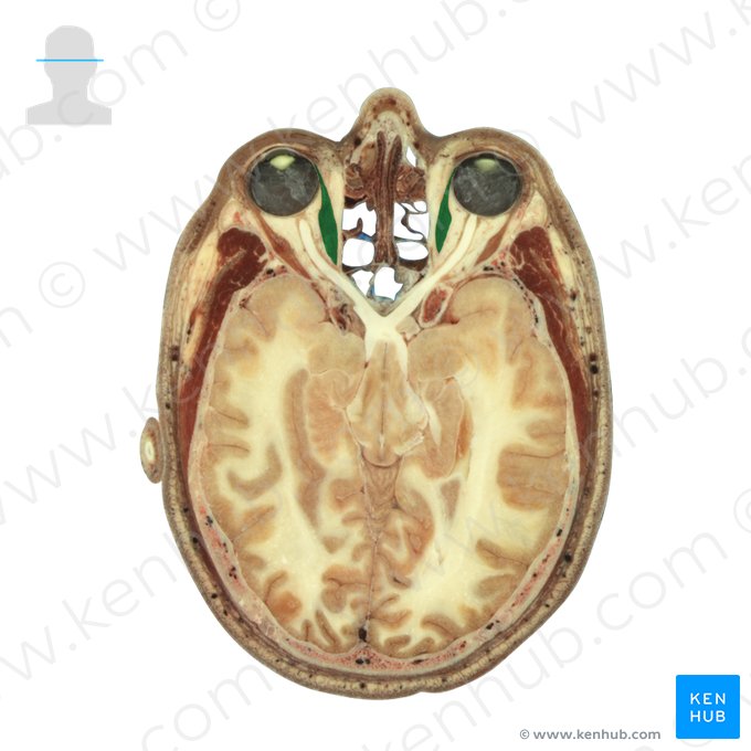 Musculus rectus medialis (Innerer gerader Augenmuskel); Bild: National Library of Medicine
