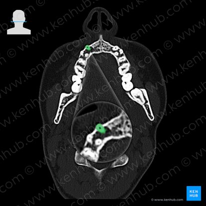 Dens caninus dexter maxillaris (Rechter oberer Eckzahn); Bild: 