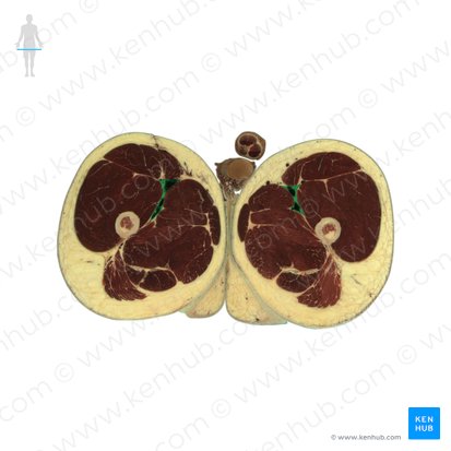 Canalis adductorius (Adduktorenkanal); Bild: National Library of Medicine