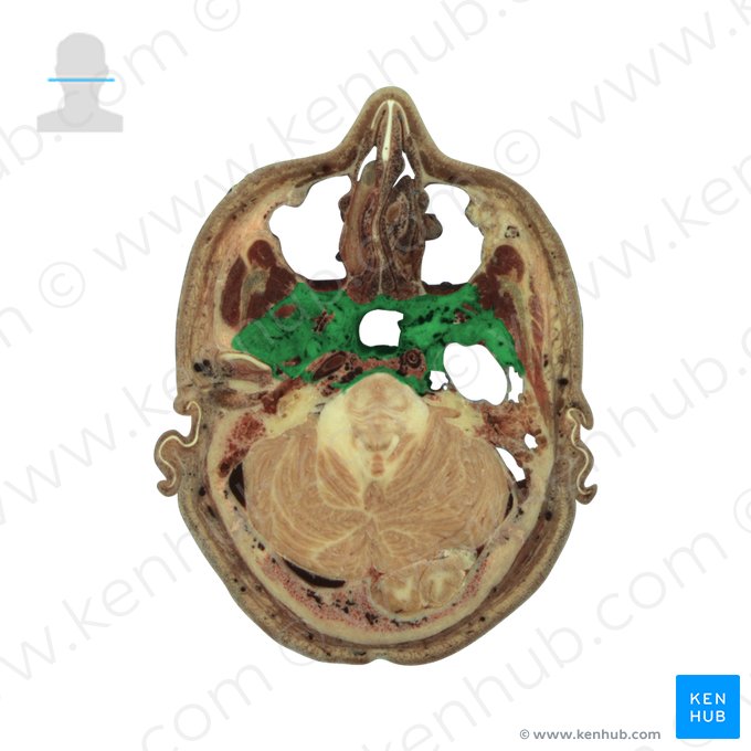 Sphenoid bone (Os sphenoidale); Image: National Library of Medicine