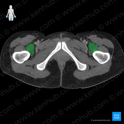 Musculus iliopsoas (Darmbein-Lenden-Muskel); Bild: 
