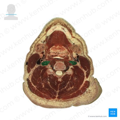 Longus capitis muscle (Musculus longus capitis); Image: National Library of Medicine