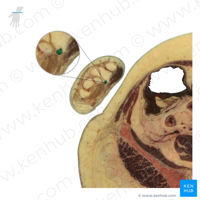 Tendon of flexor carpi radialis muscle (Tendo musculi flexoris carpi radialis); Image: National Library of Medicine