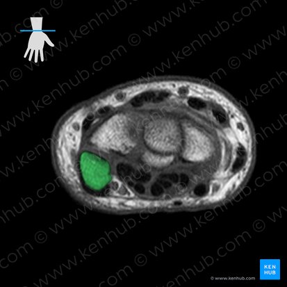 Pisiform bone (Os pisiforme); Image: 