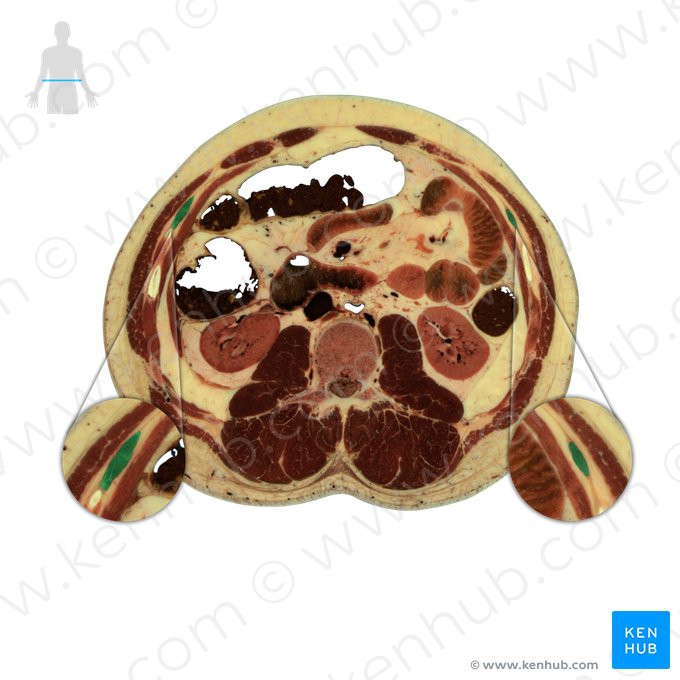 Músculo oblíquo interno do abdome (Musculus obliquus internus abdominis); Imagem: National Library of Medicine