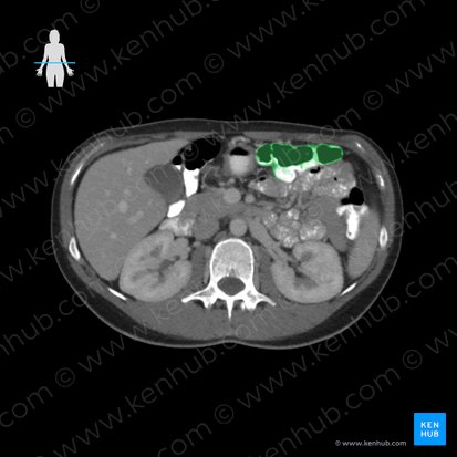 Transverse colon (Colon transversum); Image: 