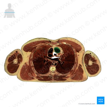 Ventrículo direito do coração (Ventriculus dexter cordis); Imagem: National Library of Medicine