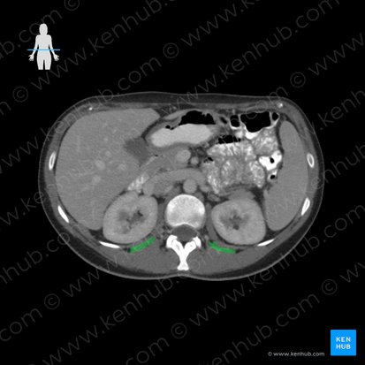 Musculus quadratus lumborum (Viereckiger Lendenmuskel); Bild: 