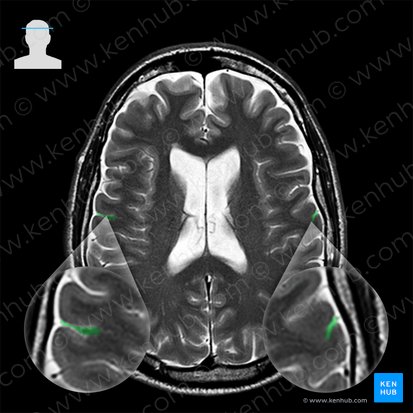 Sulcus centralis (Zentralfurche); Bild: 