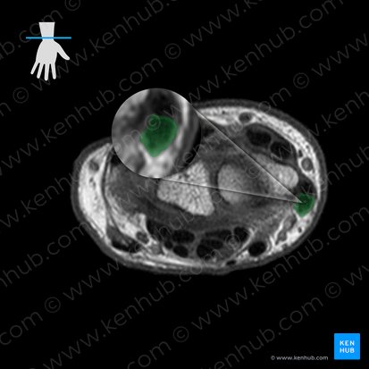 Tendon of abductor pollicis longus muscle (Tendo musculi abductoris pollicis longi); Image: 