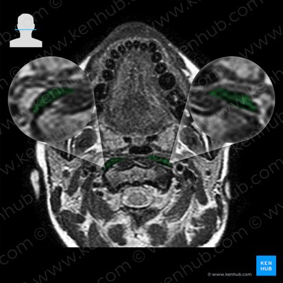 Longus capitis muscle (Musculus longus capitis); Image: 