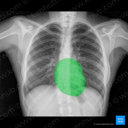 Cardiac silhouette; Image: 