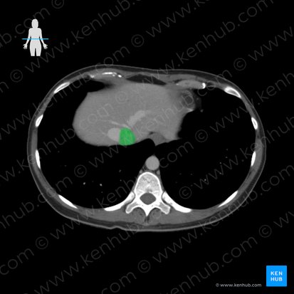 Vena cava inferior (Untere Hohlvene); Bild: 