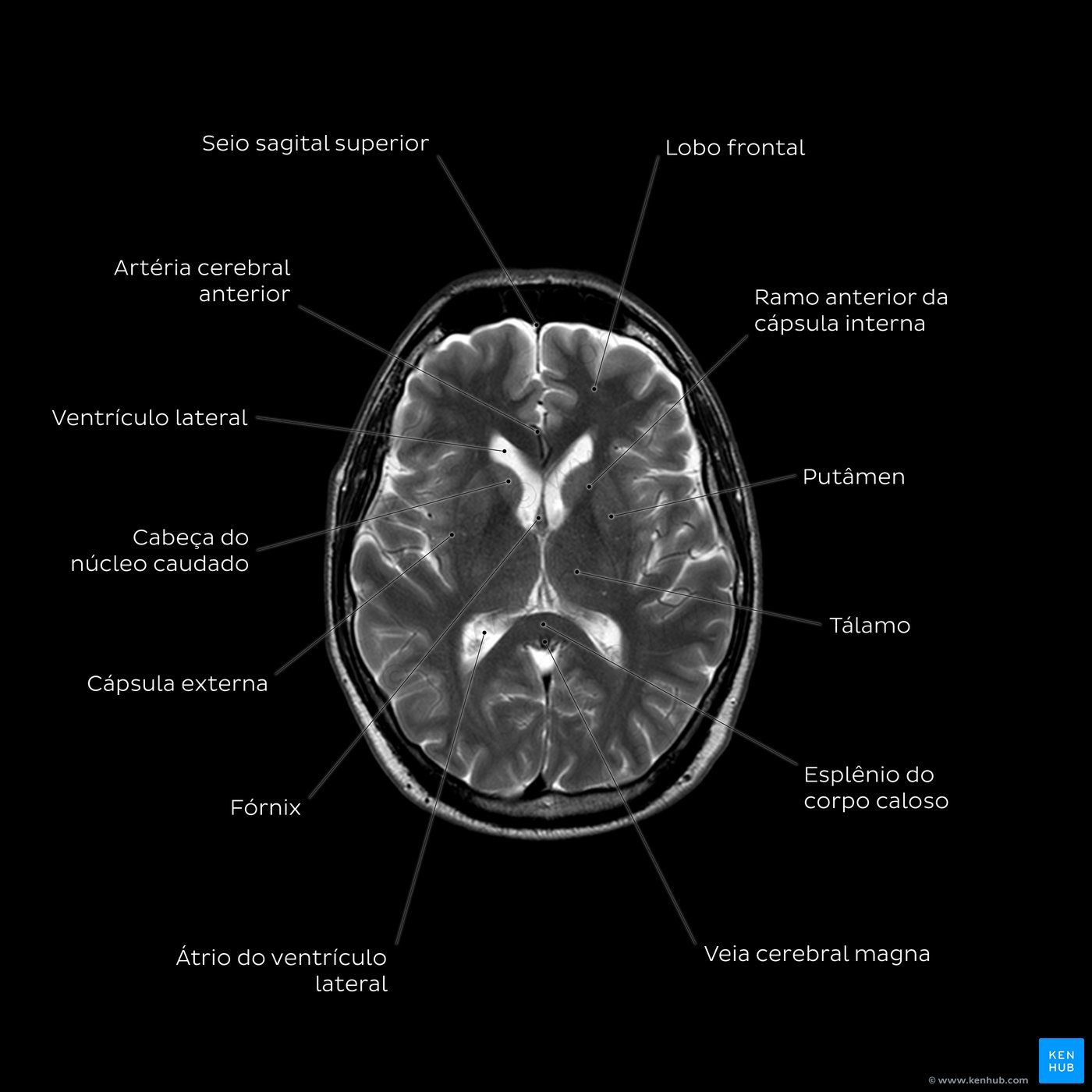 Brain MRI (T2w) - Thalamus level
