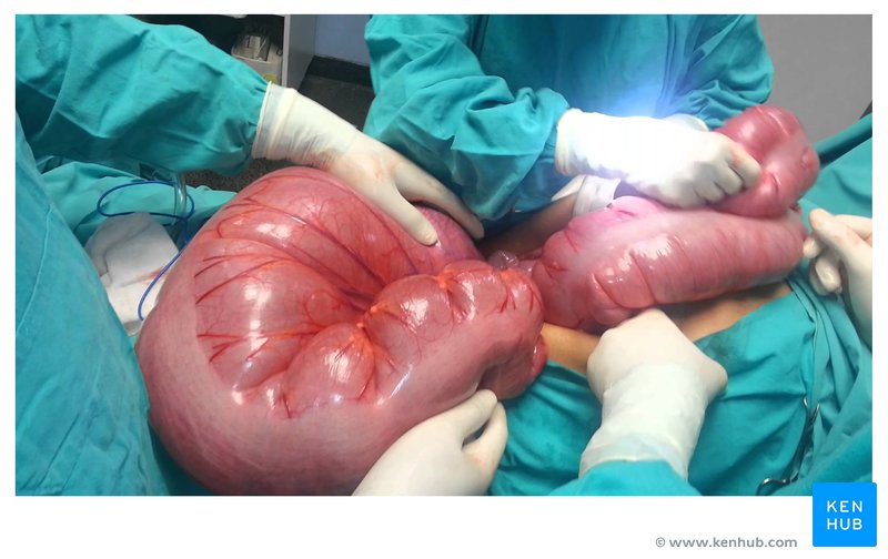 Megacolon