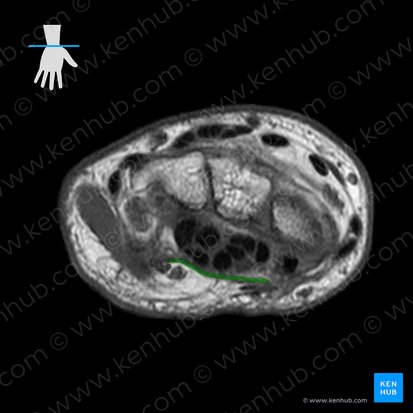 Retinaculum flexorum carpi (Halteband der Beugesehnen der Hand); Bild: 