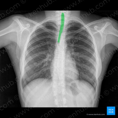 Trachea (Luftröhre); Bild: 