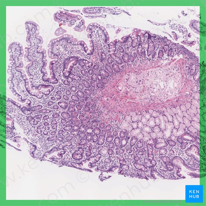 Duodenum; Image: 