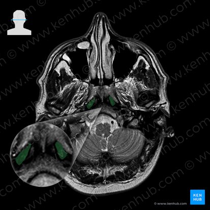 Longus capitis muscle (Musculus longus capitis); Image: 