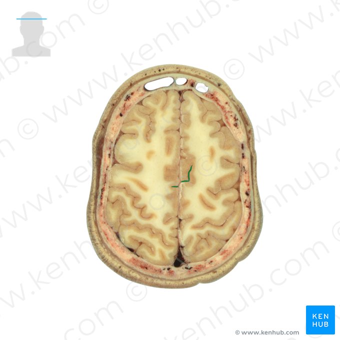 Sulcus centralis (Zentralfurche); Bild: National Library of Medicine