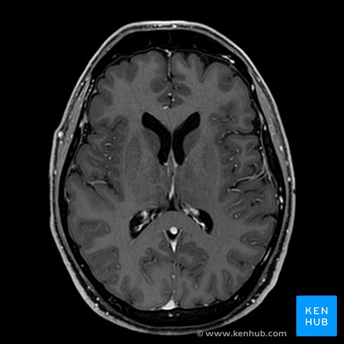 Brain MRI