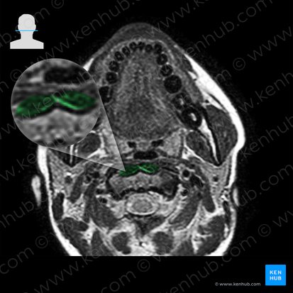 Longus colli muscle (Musculus longus colli); Image: 