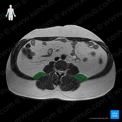 Musculus quadratus lumborum (Viereckiger Lendenmuskel); Bild: 