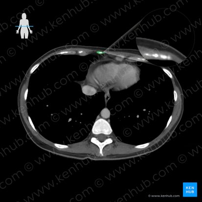Xiphoid process of sternum (Processus xiphoideus sterni); Image: 