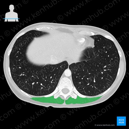 Músculo erector de la columna (Musculus erector spinae); Imagen: 